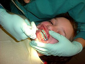 Braces cement placement