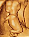 Ultrasound image of a fetus