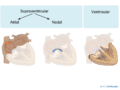 De-Atrial ventricular (CardioNetworks ECGpedia)