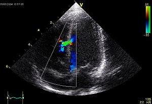 Ventricular Septal Defect