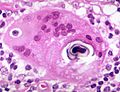 Sarcoidosis - Schaumann body 2