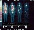 Sequence of 123-iodide total body human scintiscans