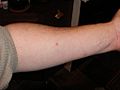 Negative Mantoux Test