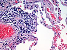 Emphysema H and E