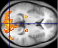 Functional magnetic resonance imaging