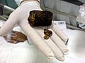 Big Gallstone