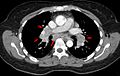 Sarkoidose1 CT axial