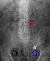 EndoStentandCoilMark