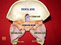 Sphenoid and temporal bones