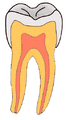 Pit-and-Fissure-Caries-GIF