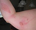 Image-Chloracetic Acid Burns