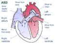 Atrial septal defect-en