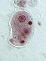 Entamoeba histolytica