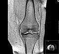 Gonarthrose-Knorpelaufbrauch