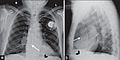 X-ray of pacemaker with right atrial and ventricular lead