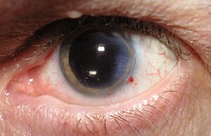 CataractOperated