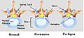 Disc Herniation