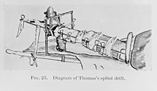 Thomas's splint, fractures. Wellcome M0019190