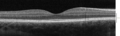 SD-OCT Macula Cross-Section