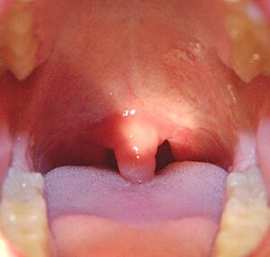 Swollenuvula