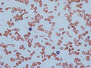 Sickle cells