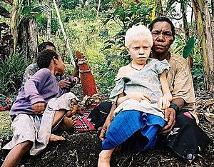 Albinistic girl papua new guinea