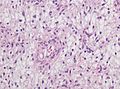 Neuropathology case V 03