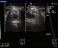 SonoAppendizitis