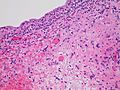 Histopathology of radiation cystitis