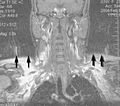 MRI with motion artifacts