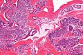 Endometrial stromal condensation high mag