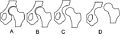 Hip dysplasia - schematic