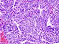 Endometrial adenocarcinoma (1)