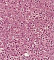 Lymphoepithelioma met to LN 6