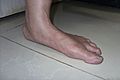 Adult Flatfoot