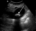 Gallstones