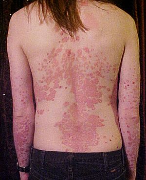 Psoriasis on back