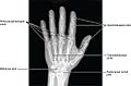 814 Radiograph of Hand