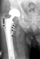 Hip joint aseptic loosening ar1938-1