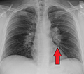 HilarAdenopathy