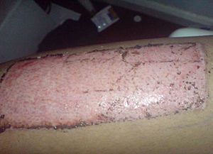 Skin graft donor site