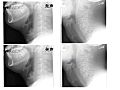 Compare epiglottis