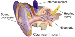 Cochlear Implant