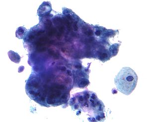 Adenocarcinoma on pap test 2