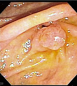 Ampulla endo.jpg