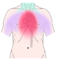 Angina pectoris