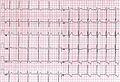 Left Ventricular Hypertrophy Unlabeled