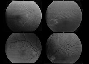 1999 Choroid folds