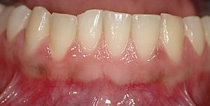 Healthy gingiva