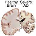 Alzheimers brain